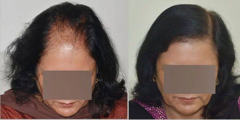 Hair Transplant