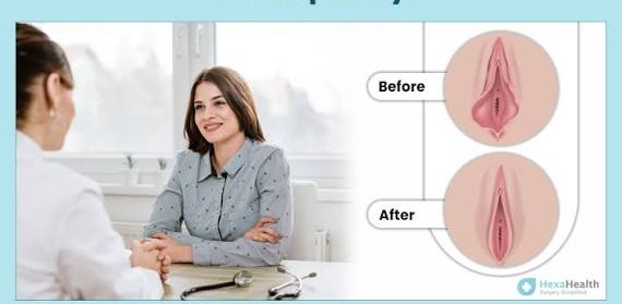 Labiaplasty