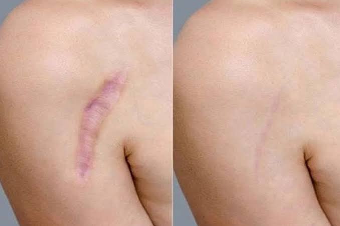 Scar Revision