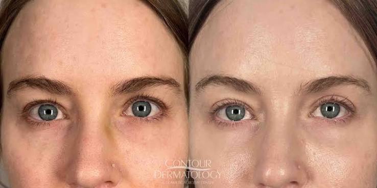 Blepharoplasty