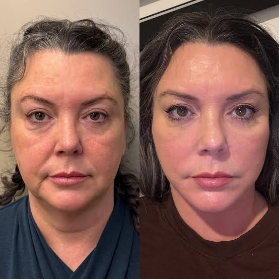 Facelift