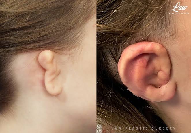 Ear Surgery