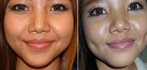 Dimple Creation