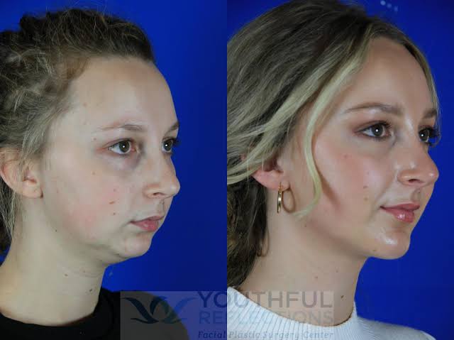 Chin Surgery
