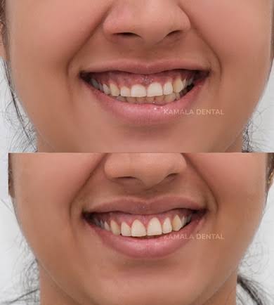 Gummy Smile