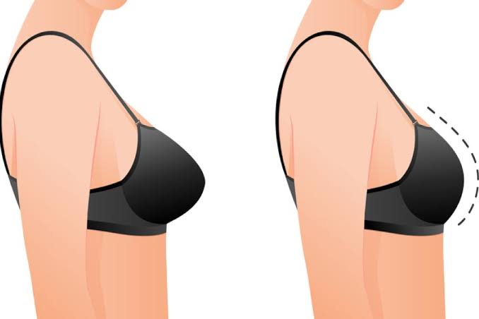 Breast Reduction