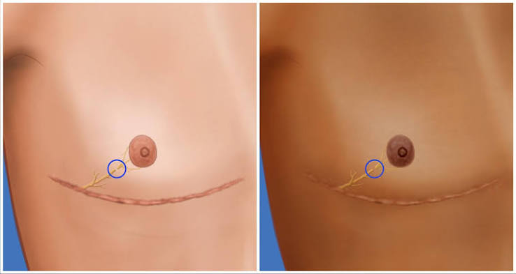 Nipple Surgery